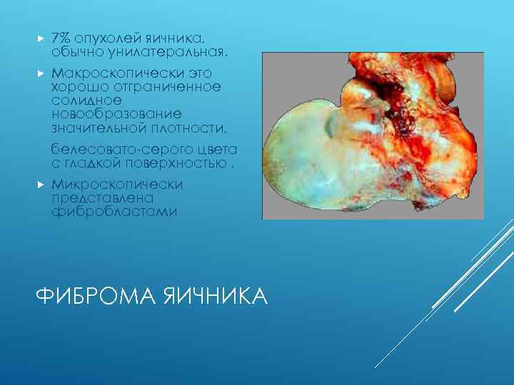 7% опухолей яичника, обычно унилатеральная. Макроскопически это хорошо отграниченное солидное новообразование значительной плотности, белесовато-серого