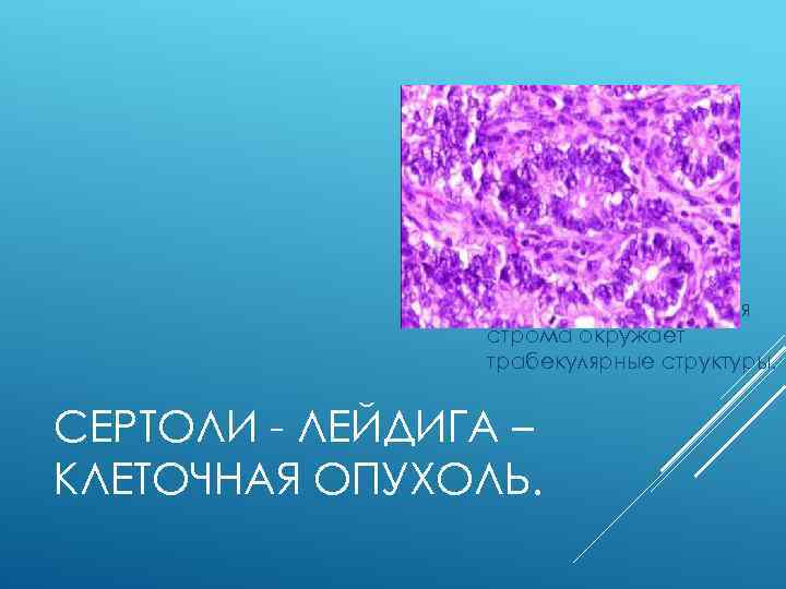  Соединительно-тканная строма окружает трабекулярные структуры. СЕРТОЛИ - ЛЕЙДИГА – КЛЕТОЧНАЯ ОПУХОЛЬ. 