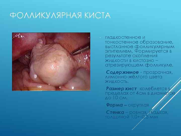 ФОЛЛИКУЛЯРНАЯ КИСТА - гладкостенное и тонкостенное образование, выстланное фолликулярным эпителием. Формируется в результате скопления