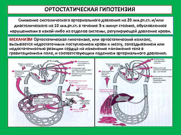 ОРТОСТАТИЧЕСКАЯ ГИПОТЕНЗИЯ Снижение систолического артериального давления на 20 мм. рт. ст. и/или диастолического на