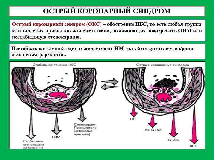 Острый коронарный синдром карта вызова