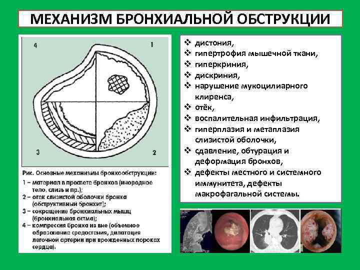 МЕХАНИЗМ БРОНХИАЛЬНОЙ ОБСТРУКЦИИ v v v v v дистония, гипертрофия мышечной ткани, гиперкриния, дискриния,