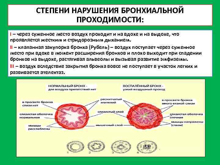 СТЕПЕНИ НАРУШЕНИЯ БРОНХИАЛЬНОЙ ПРОХОДИМОСТИ: I – через суженное место воздух проходит и на вдохе