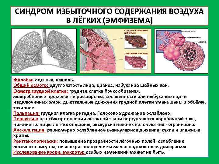 СИНДРОМ ИЗБЫТОЧНОГО СОДЕРЖАНИЯ ВОЗДУХА В ЛЁГКИХ (ЭМФИЗЕМА) Жалобы: одышка, кашель. Общий осмотр: одутловатость лица,