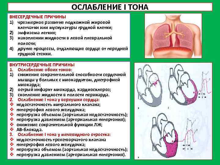 ОСЛАБЛЕНИЕ I ТОНА ВНЕСЕРДЕЧНЫЕ ПРИЧИНЫ 1) чрезмерное развитие подкожной жировой клетчатки или мускулатуры грудной