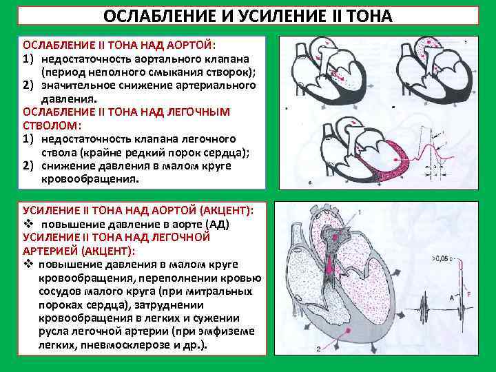 ОСЛАБЛЕНИЕ И УСИЛЕНИЕ II ТОНА ОСЛАБЛЕНИЕ II ТОНА НАД АОРТОЙ: 1) недостаточность аортального клапана