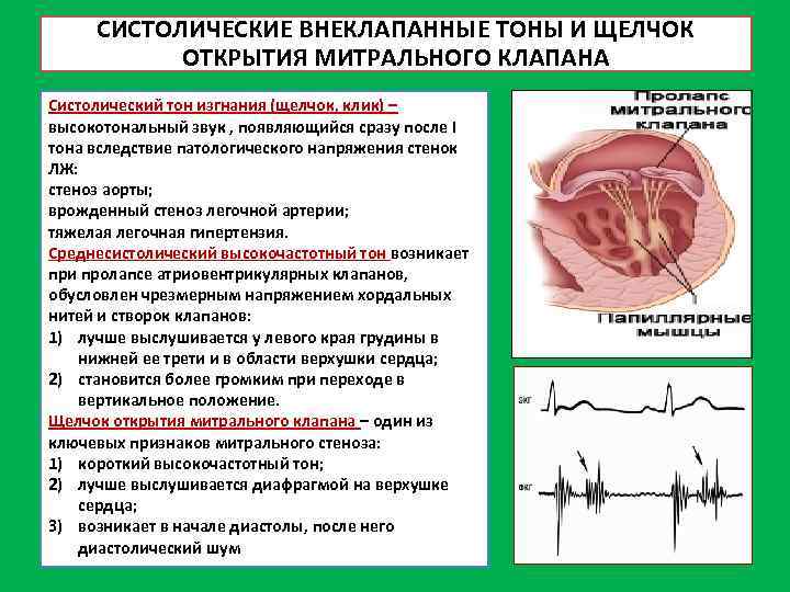 СИСТОЛИЧЕСКИЕ ВНЕКЛАПАННЫЕ ТОНЫ И ЩЕЛЧОК ОТКРЫТИЯ МИТРАЛЬНОГО КЛАПАНА Систолический тон изгнания (щелчок, клик) –