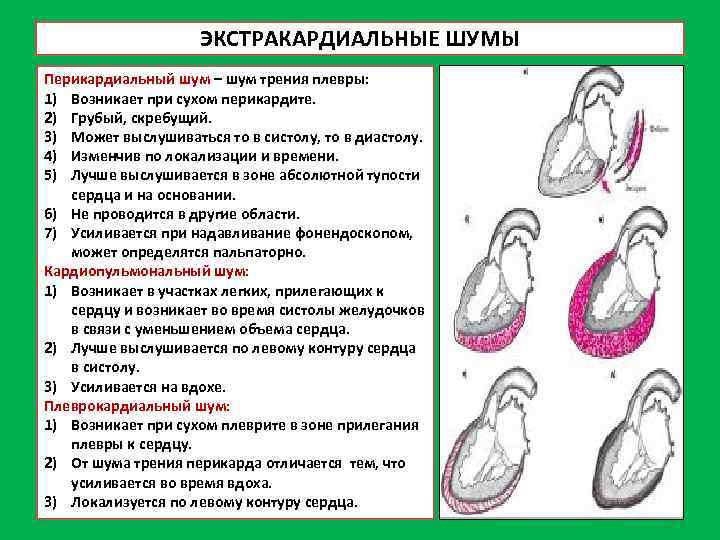 ЭКСТРАКАРДИАЛЬНЫЕ ШУМЫ Перикардиальный шум – шум трения плевры: 1) Возникает при сухом перикардите. 2)