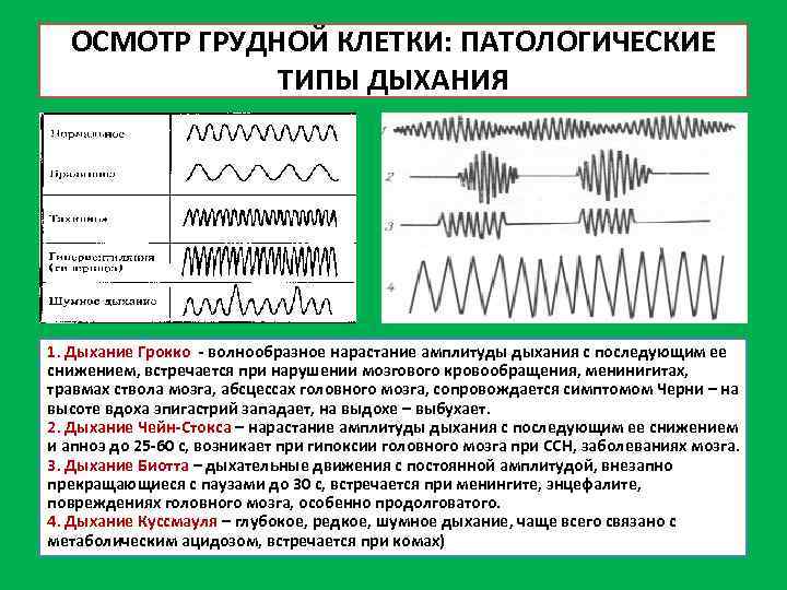 ОСМОТР ГРУДНОЙ КЛЕТКИ: ПАТОЛОГИЧЕСКИЕ ТИПЫ ДЫХАНИЯ 1. Дыхание Грокко - волнообразное нарастание амплитуды дыхания