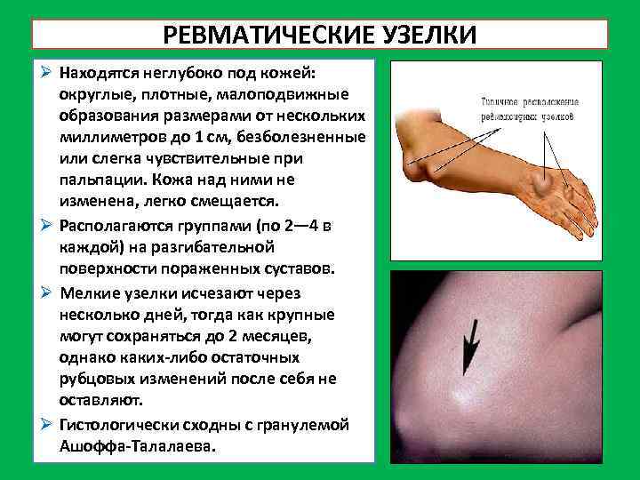 Узелки бона на деснах фото