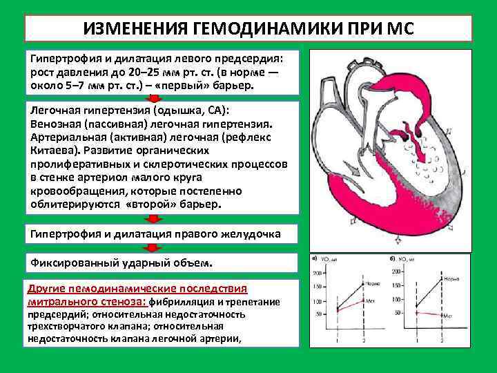 ИЗМЕНЕНИЯ ГЕМОДИНАМИКИ ПРИ МС Гипертрофия и дилатация левого предсердия: рост давления до 20– 25