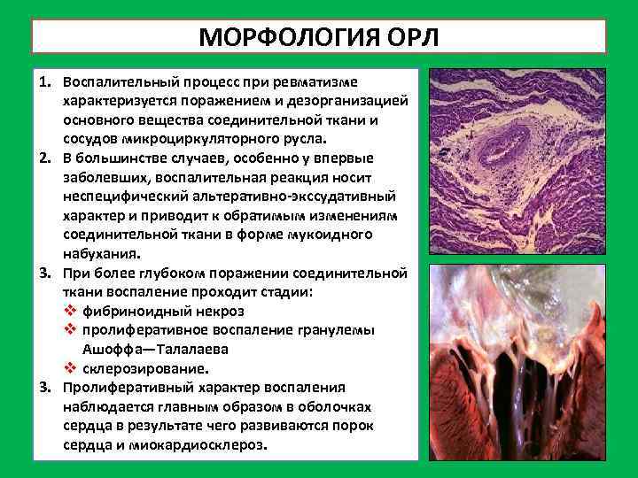 Особенности сестринского процесса при ревматизме первичной атаке схема