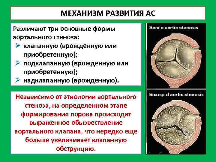 МЕХАНИЗМ РАЗВИТИЯ АС Различают три основные формы аортального стеноза: Ø клапанную (врожденную или приобретенную);