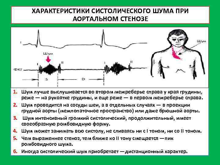 Аускультативная картина аортального стеноза