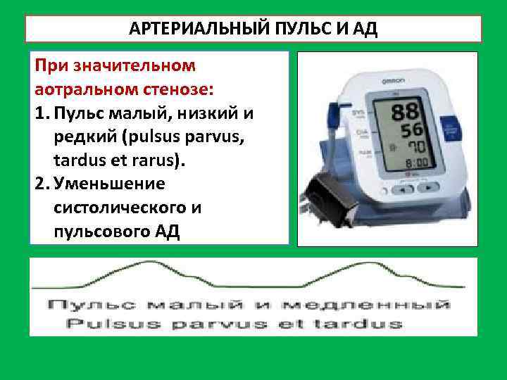 АРТЕРИАЛЬНЫЙ ПУЛЬС И АД При значительном аотральном стенозе: 1. Пульс малый, низкий и редкий