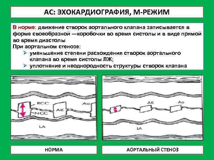 Протезирование аортального клапана мкб