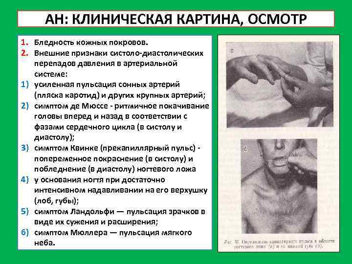 АН: КЛИНИЧЕСКАЯ КАРТИНА, ОСМОТР 1. Бледность кожных покровов. 2. Внешние признаки систоло-диастолических перепадов давления