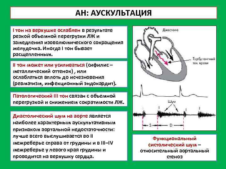 Аускультативная картина i тона сердца при стенозе устья аорты