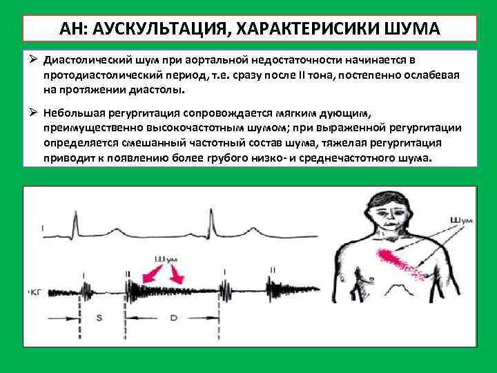 Какие симптомы характерны для аускультативной картины недостаточности митрального клапана тест