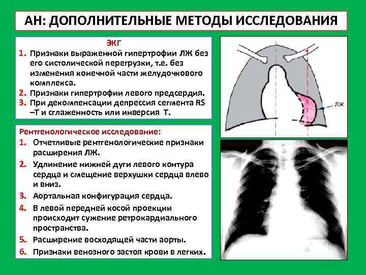 Систолическая перегрузка на экг