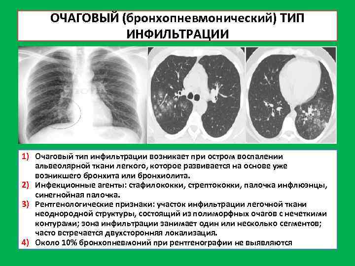 ОЧАГОВЫЙ (бронхопневмонический) ТИП ИНФИЛЬТРАЦИИ 1) Очаговый тип инфильтрации возникает при остром воспалении альвеолярной ткани