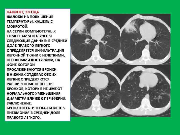 ПАЦИЕНТ, 32 ГОДА ЖАЛОБЫ НА ПОВЫШЕНИЕ ТЕМПЕРАТУРЫ, КАШЕЛЬ С МОКРОТОЙ. НА СЕРИИ КОМПЬЮТЕРНЫХ ТОМОГРАММ