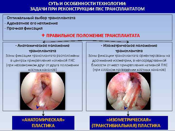 СУТЬ И ОСОБЕННОСТИ ТЕХНОЛОГИИ: ЗАДАЧИ ПРИ РЕКОНСТРУКЦИИ ПКС ТРАНСПЛАНТАТОМ - Оптимальный выбор трансплантата -