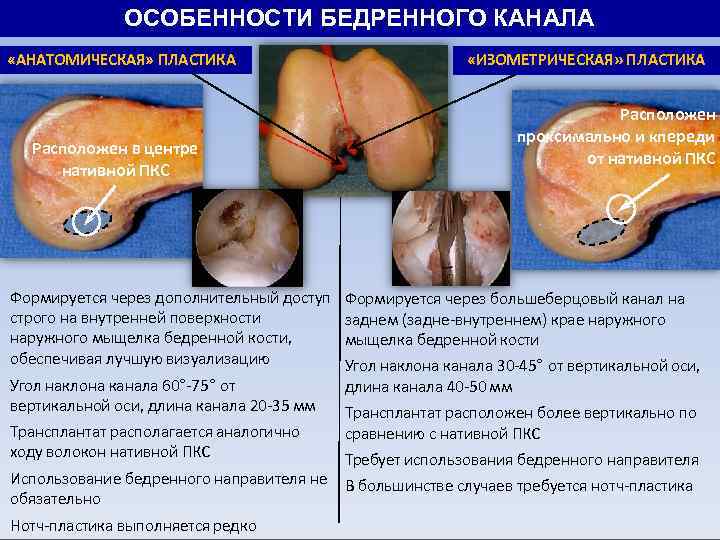ОСОБЕННОСТИ БЕДРЕННОГО КАНАЛА «АНАТОМИЧЕСКАЯ» ПЛАСТИКА Расположен в центре нативной ПКС Формируется через дополнительный доступ
