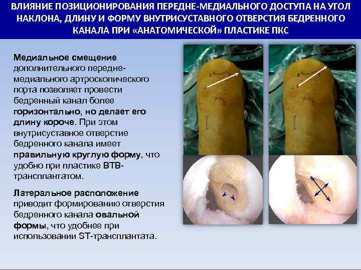 ВЛИЯНИЕ ПОЗИЦИОНИРОВАНИЯ ПЕРЕДНЕ-МЕДИАЛЬНОГО ДОСТУПА НА УГОЛ НАКЛОНА, ДЛИНУ И ФОРМУ ВНУТРИСУСТАВНОГО ОТВЕРСТИЯ БЕДРЕННОГО КАНАЛА
