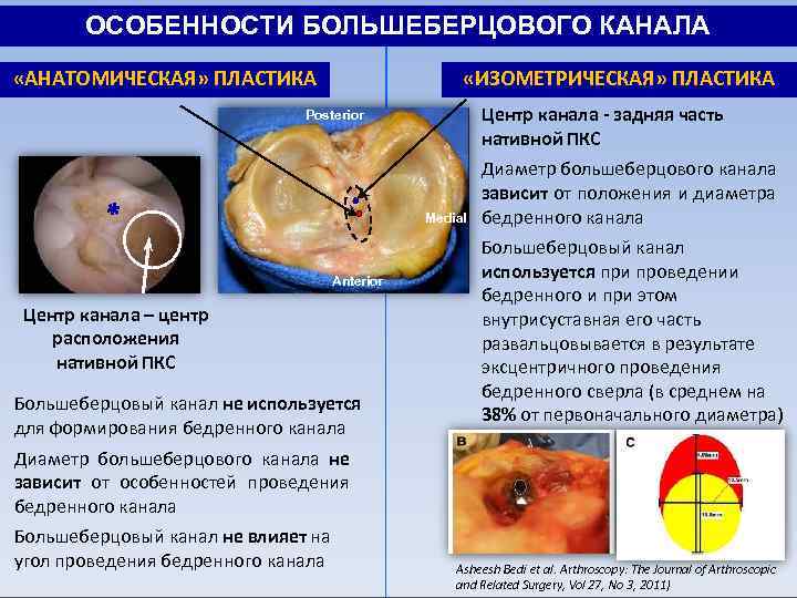 ОСОБЕННОCТИ БОЛЬШЕБЕРЦОВОГО КАНАЛА «АНАТОМИЧЕСКАЯ» ПЛАСТИКА «ИЗОМЕТРИЧЕСКАЯ» ПЛАСТИКА Центр канала - задняя часть нативной ПКС