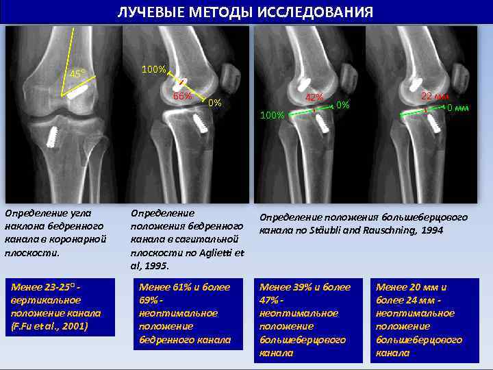 ЛУЧЕВЫЕ МЕТОДЫ ИССЛЕДОВАНИЯ 45° 100% 66% 0% Определение угла наклона бедренного канала в коронарной