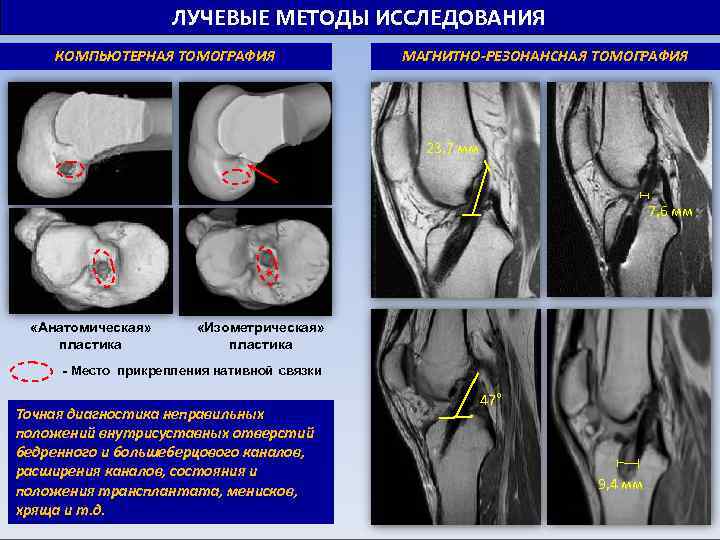 ЛУЧЕВЫЕ МЕТОДЫ ИССЛЕДОВАНИЯ КОМПЬЮТЕРНАЯ ТОМОГРАФИЯ МАГНИТНО-РЕЗОНАНСНАЯ ТОМОГРАФИЯ 23, 7 мм 7, 6 мм *