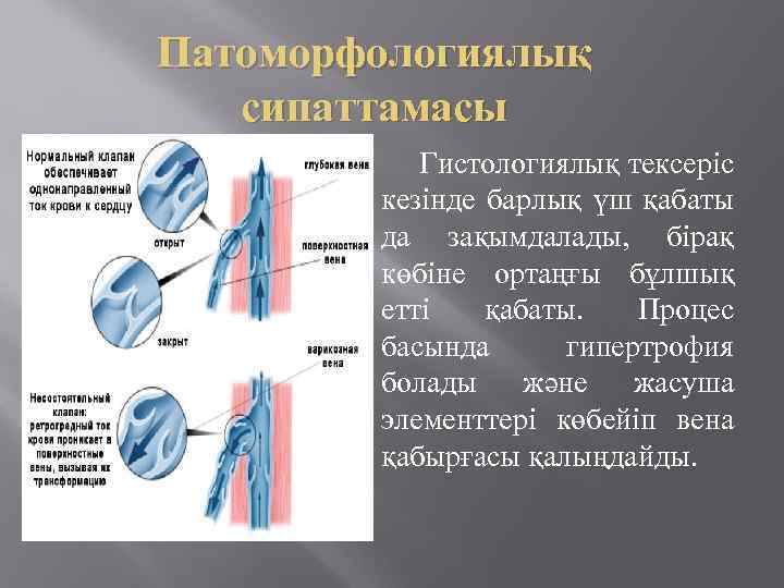 Патоморфологиялық сипаттамасы Гистологиялық тексеріс кезінде барлық үш қабаты да зақымдалады, бірақ көбіне ортаңғы бұлшық