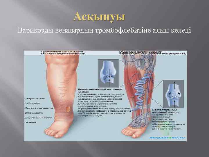 Асқынуы Варикозды веналардың тромбофлебитіне алып келеді 
