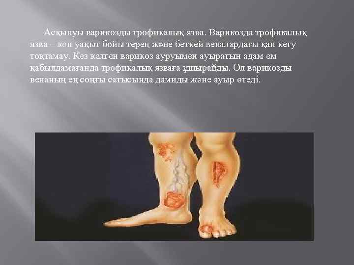 Асқынуы варикозды трофикалық язва. Варикозда трофикалық язва – көп уақыт бойы терең және беткей