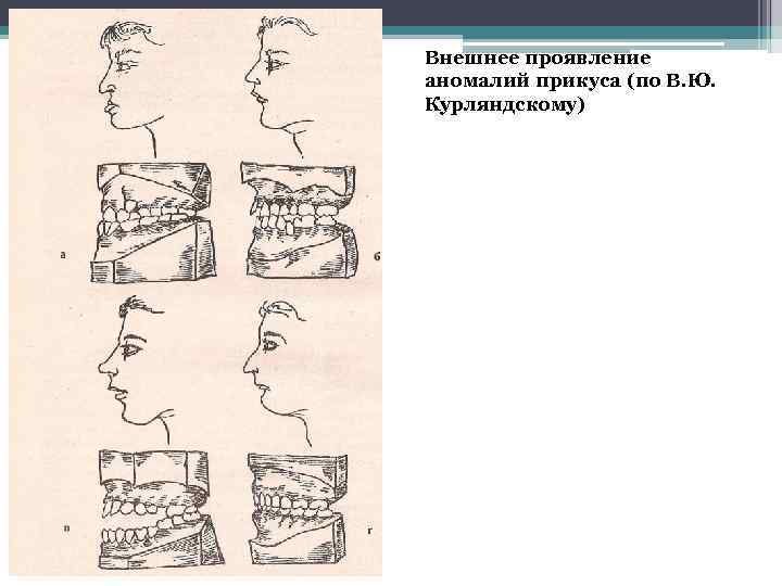 Внешнее проявление аномалий прикуса (по В. Ю. Курляндскому) 