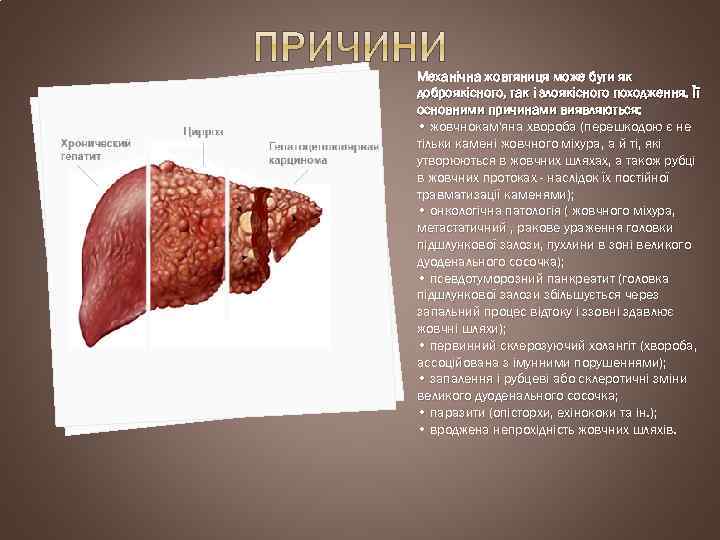 Механічна жовтяниця може бути як доброякісного, так і злоякісного походження. Її основними причинами виявляються: