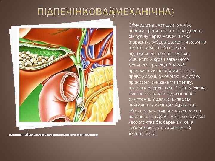 Зменшення об’єму жовчного міхура внаслідок накопичення каменів об’ Обумовлена зменшенням або повним припиненням проходження