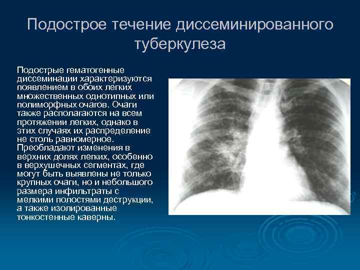 Подострое течение диссеминированного туберкулеза Подострые гематогенные диссеминации характеризуются появлением в обоих легких множественных однотипных