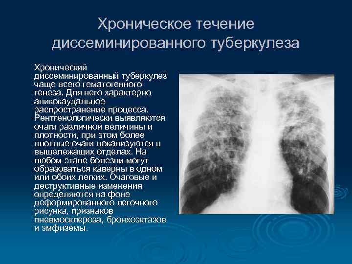 Хроническое течение диссеминированного туберкулеза Хронический диссеминированный туберкулез чаще всего гематогенного генеза. Для него характерно