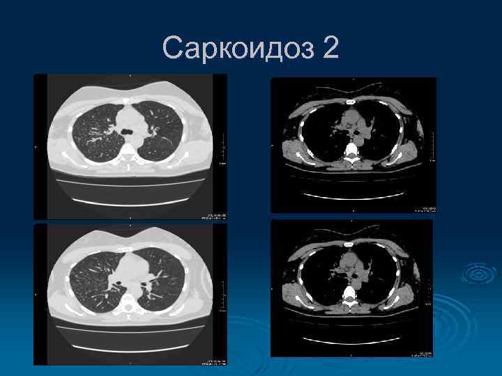 Саркоидоз 2 