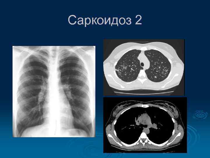 Саркоидоз 2 