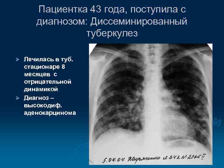 Пациентка 43 года, поступила с диагнозом: Диссеминированный туберкулез Лечилась в туб. стационаре 8 месяцев