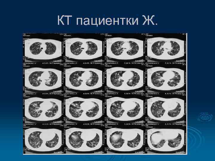КТ пациентки Ж. 