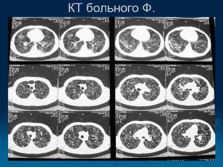 КТ больного Ф. 