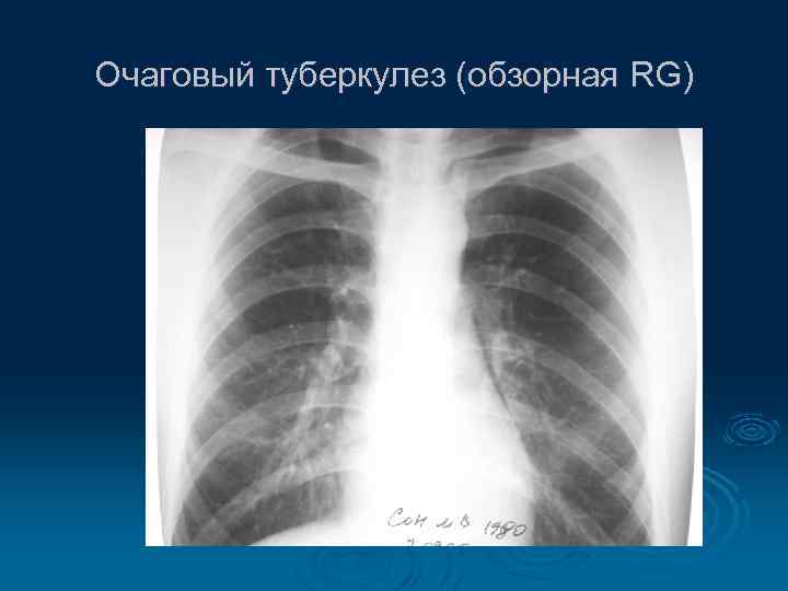 Очаговый туберкулез (обзорная RG) 