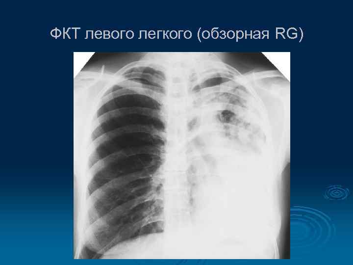 ФКТ левого легкого (обзорная RG) 