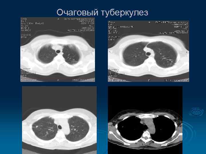 Очаговый туберкулез 
