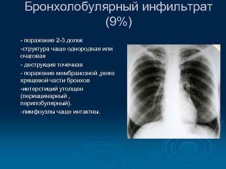 Бронхолобулярный инфильтрат (9%) - поражение 2 -3 долек -структура чаще однородная или очаговая -