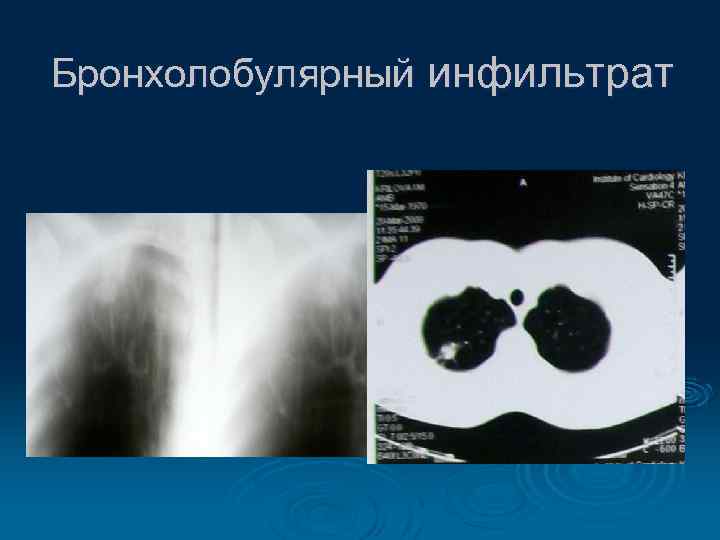 Бронхолобулярный инфильтрат 